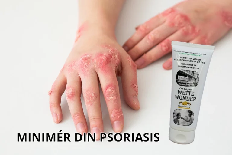 minimering af psoriasis